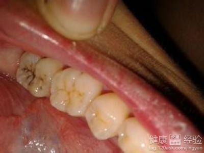 牙齒矯正有風險嗎