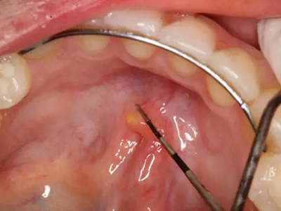口腔潰瘍會不會發展成為口腔癌？