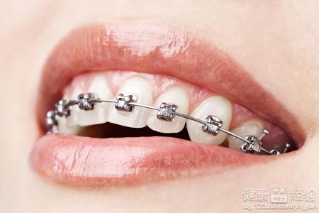 牙齒矯正一般都要經過哪些過程