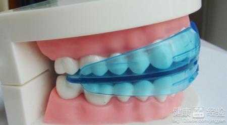 牙齒矯正器的種類有哪些