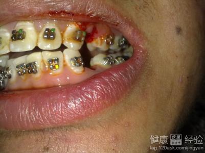 牙齒矯正保持器要帶多久?