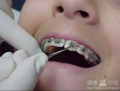 兒童戴牙齒矯正器需要注意什麼