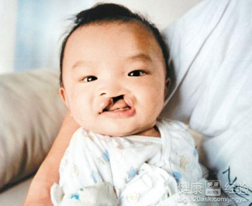 怎麼照顧唇腭裂嬰兒