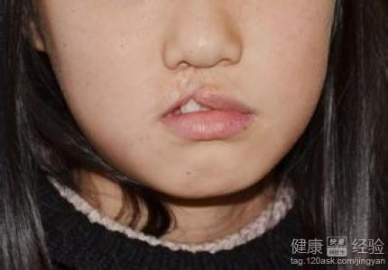 28歲女性唇腭裂，單條，較嚴重如何整形