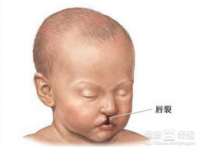 新生兒先天性唇腭裂應該如何治療
