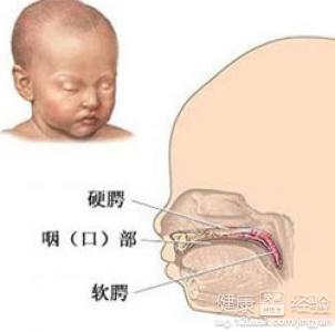 患有心衰做唇腭裂手術要注意什麼