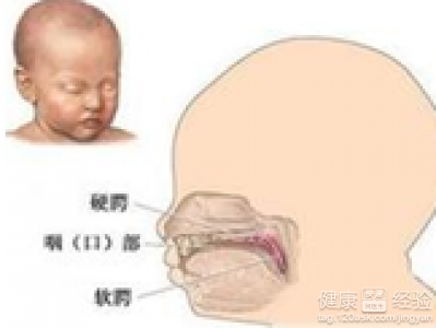 怎樣可以預防胎兒的唇腭裂