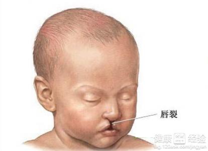 嬰兒唇腭裂總是眼干怎麼辦