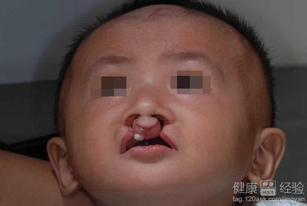 以前做過唇腭裂手術沒有做好，現在想重新修復怎麼辦