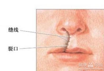 已經做了兩次唇腭裂手術，現在上腭還有一處裂開怎麼辦