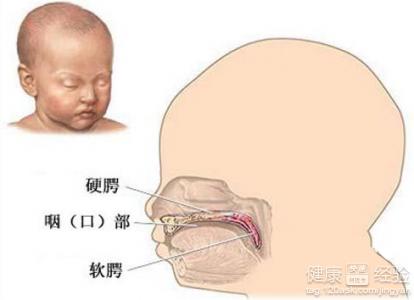 唇腭裂先前反映有哪些