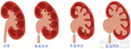 寶寶出生30小時唇腭裂，左腎積水怎麼辦