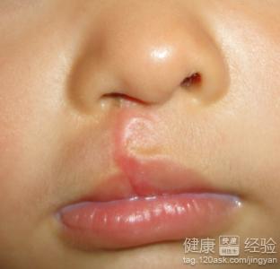 唇腭裂成年後怎麼治療