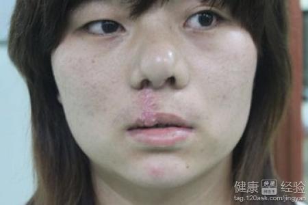 19歲唇腭裂之前做過三次的修復手術還沒有治愈怎麼辦