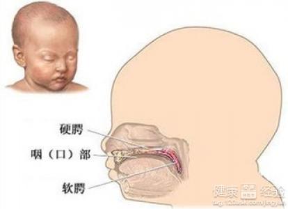 因家庭貧困無法治療新生兒唇腭裂怎麼辦