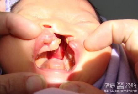 小兒先天性唇腭裂徹底治療有哪些方法