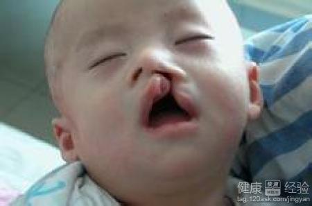 唇腭裂嬰兒飲食應該注意什麼？