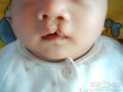 嬰兒唇腭裂與那些因素有關？