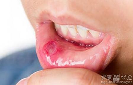口腔潰瘍常見原因有八種