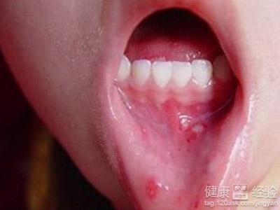 治療復發性口腔潰瘍的食療小偏方