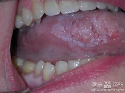 經常口腔潰瘍會造成哪些危害