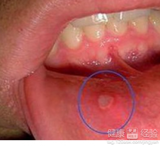 口腔潰瘍可能是“癌信號”