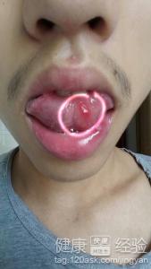 口腔潰瘍舌尖疼怎麼治療