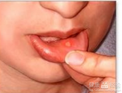 口腔潰瘍應該注意什麼