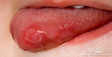 口腔潰瘍到底是怎樣的疾病？