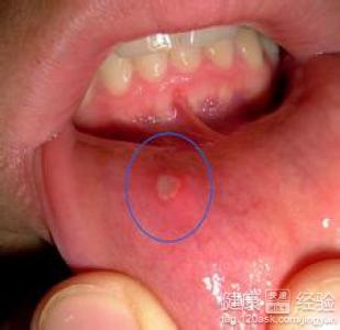口腔潰瘍如何治？