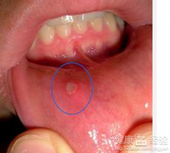 嘴巴潰瘍的治療方法有哪些