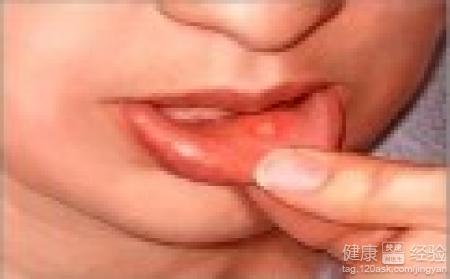 口腔潰瘍，舌苔厚如何中藥調理