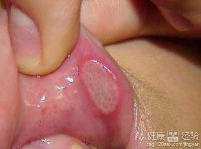 口腔潰瘍最好的治療方法
