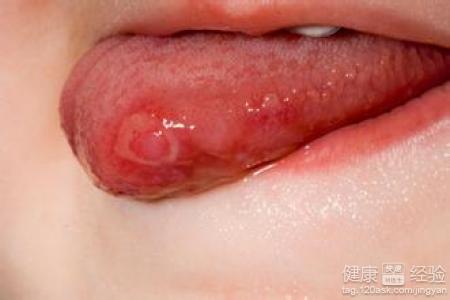 口腔潰瘍經常復發怎麼回事