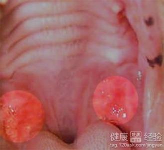 口腔潰瘍什麼原因引起的