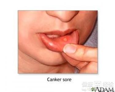 口腔反復潰瘍是什麼原因