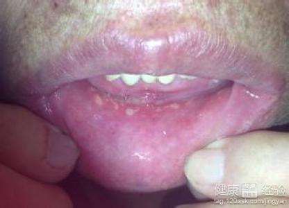 口腔經常潰瘍什麼原因
