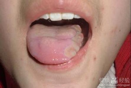 口腔經常潰瘍是什麼原因