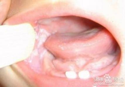 口腔潰瘍的快速治療方法