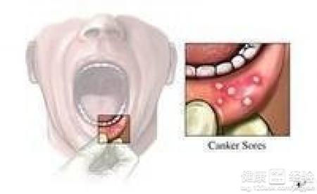 口腔潰瘍經常復發怎麼辦