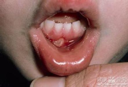 舌苔發黃口腔潰瘍，如何避免上火