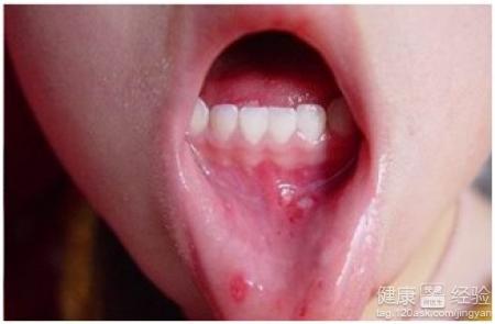 小兒口腔潰瘍引起發燒怎麼辦
