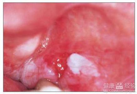 經常容易口腔潰瘍口舌生瘡怎麼辦