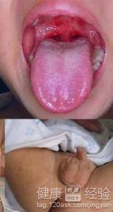 口腔潰瘍嘴角開裂怎麼處理