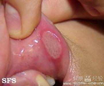 口腔潰瘍經常發作如何安排作息時間