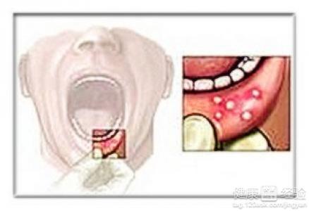 如何區分口腔潰瘍還是口腔癌