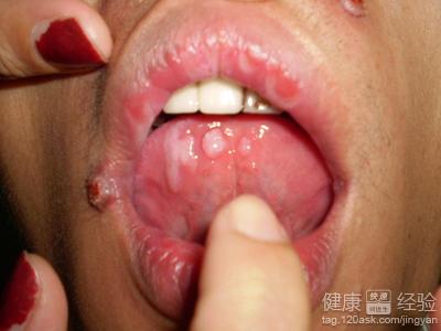 經常口腔潰瘍是怎麼回事？