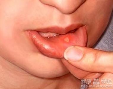 得了口腔潰瘍平時的時候怎麼治療？