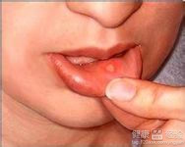 口腔潰瘍治療方法？