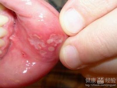 常見的口腔潰瘍症狀有什麼